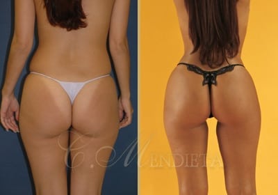 Before & After Miami Thong Lift Patient 02 Photos
